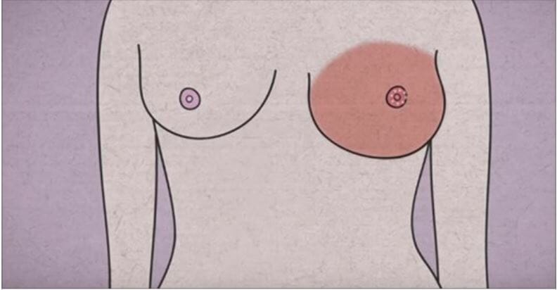 Your body warns you before breast cancer - 5 warning signs that should not be ignored