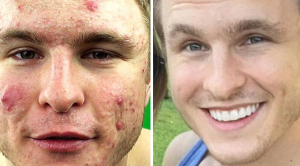 He suffered from severe acne all his life. Once he gave up this food, it was gone