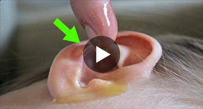 He drips a mixture of vinegar and alcohol into the ear for 60 seconds. The result? Amazing!
