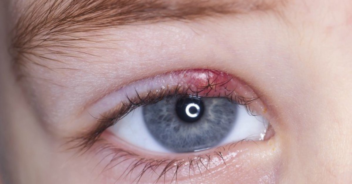 If you wake up in the morning and your eye looks like this - do this immediately!