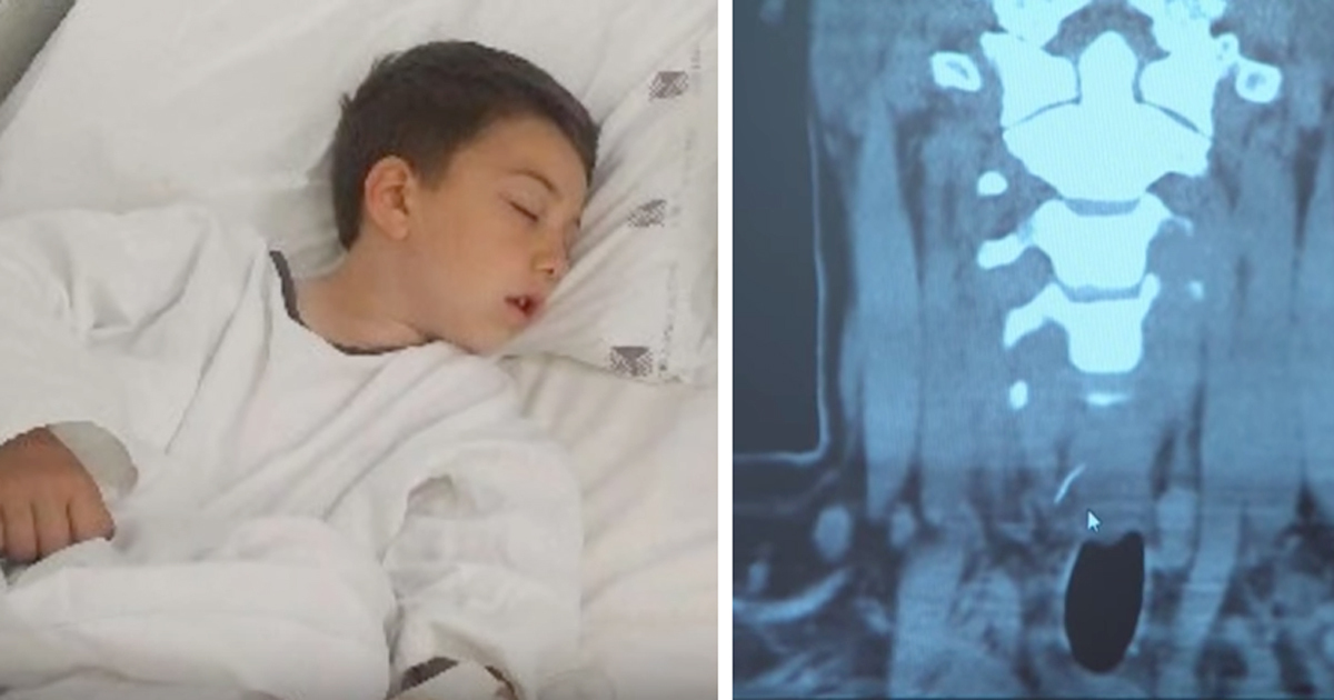 This boy had terrible pain in his stomach after eating a burger - in the hospital they discovered the shocking reason