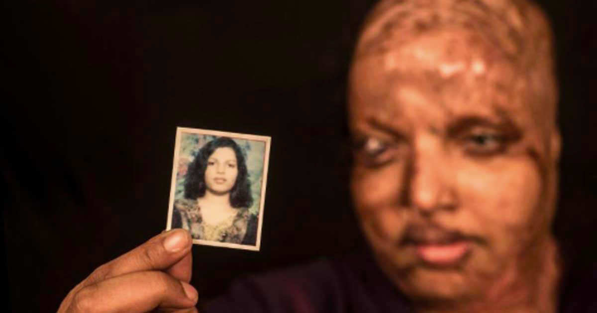 Her ex threw acid on her face - now look how she looks 10 years later