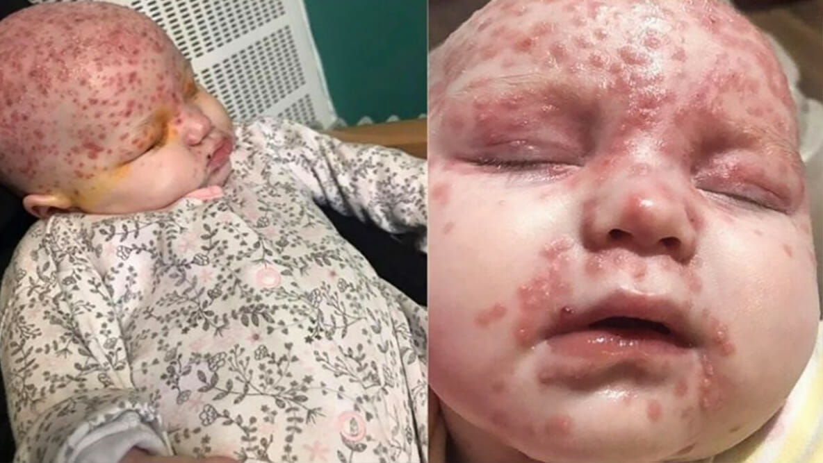 A 6-month-old baby was infected with herpes through an innocent kiss, her mother warns parents of the danger