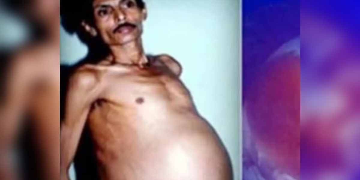 He was mocked as 'pregnant' for years, but the surgery revealed a shocking truth He was mocked as 'pregnant' for years, but the surgery revealed a shocking truth
