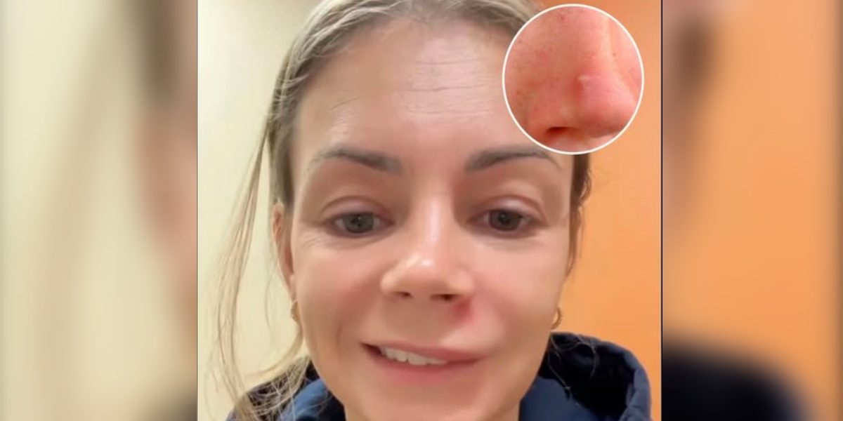 Mother of three rushed to icu after popping a pimple - doctors warn of the 'triangle of death'