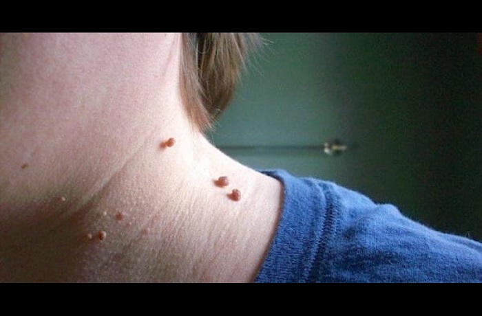 She removed a skin tag with a simple ingredient that everyone has at home. I'd never think of that!