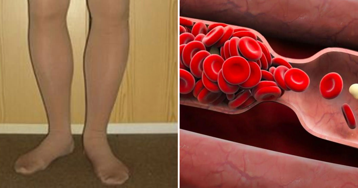 Your body warns you before a blood clot: 8 hidden signs that must never be ignored!