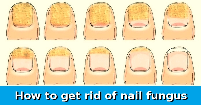 With only 2 ingredients you will be able to quickly and easily get rid of nail fungus