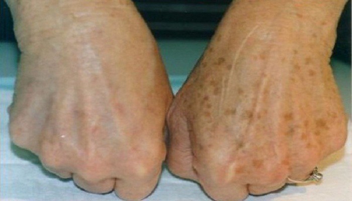 She noticed age spots on her hands, then removed them with two natural ingredients
