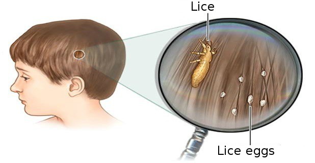 Doctors will not reveal this to you - a cheap, effective and natural way to get rid of lice immediately!