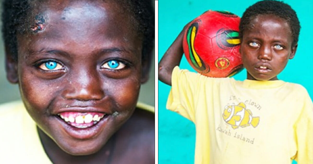 Meet the Ethiopian boy whose special blue eyes have made him famous all over the world