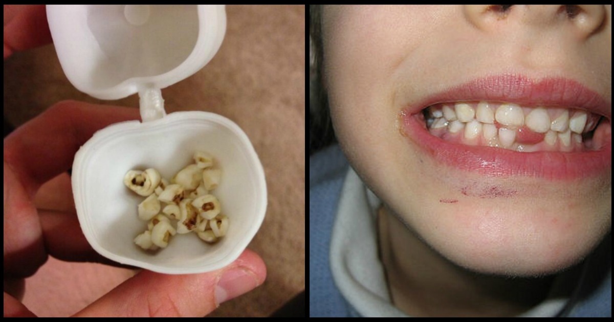 Doctors warn parents not to throw away their children's baby teeth! Here's why
