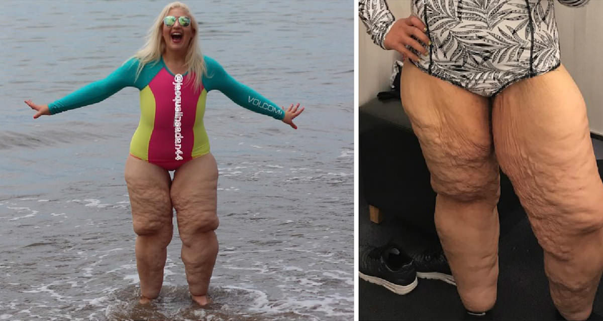 Bullies laughed at her 'ugly' legs - but what she did in response silenced them all