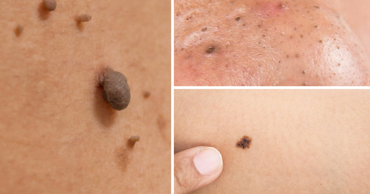 Doctors reveal: get rid of blackheads, warts and skin rashes with this simple trick