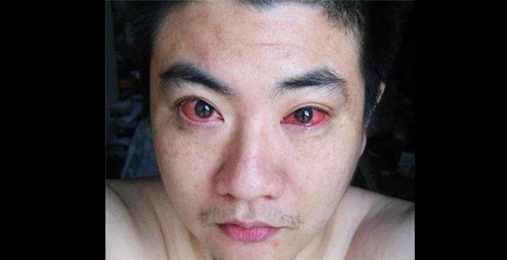 A 40-year-old man was diagnosed with eye cancer because he did this every night!
