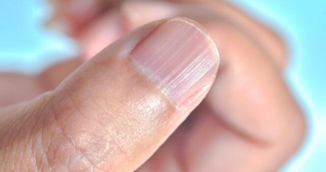 Do you have vertical lines on your nails? They could tell you something important about your health