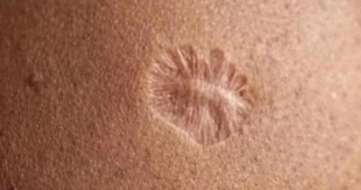 Have this round scar on your arm? here's why millions have the exact same mark